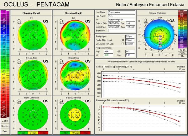 Важность диагностического обследования на аппарате Pentacam перед лазерной коррекцией зрения